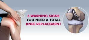 Top Signs You May Need a Knee Replacement and What to Expect
