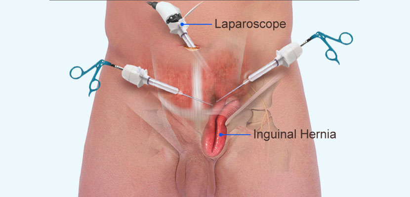 Advantages of Laparoscopic Hernia Surgery