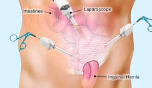 Preparing for Laparoscopic Hernia Surgery