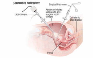 Recovery After TLH Hysterectomy