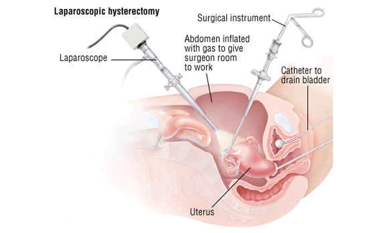 Recovery After TLH Hysterectomy