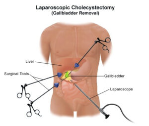 Signs You Need Laparoscopic Cholecystectomy